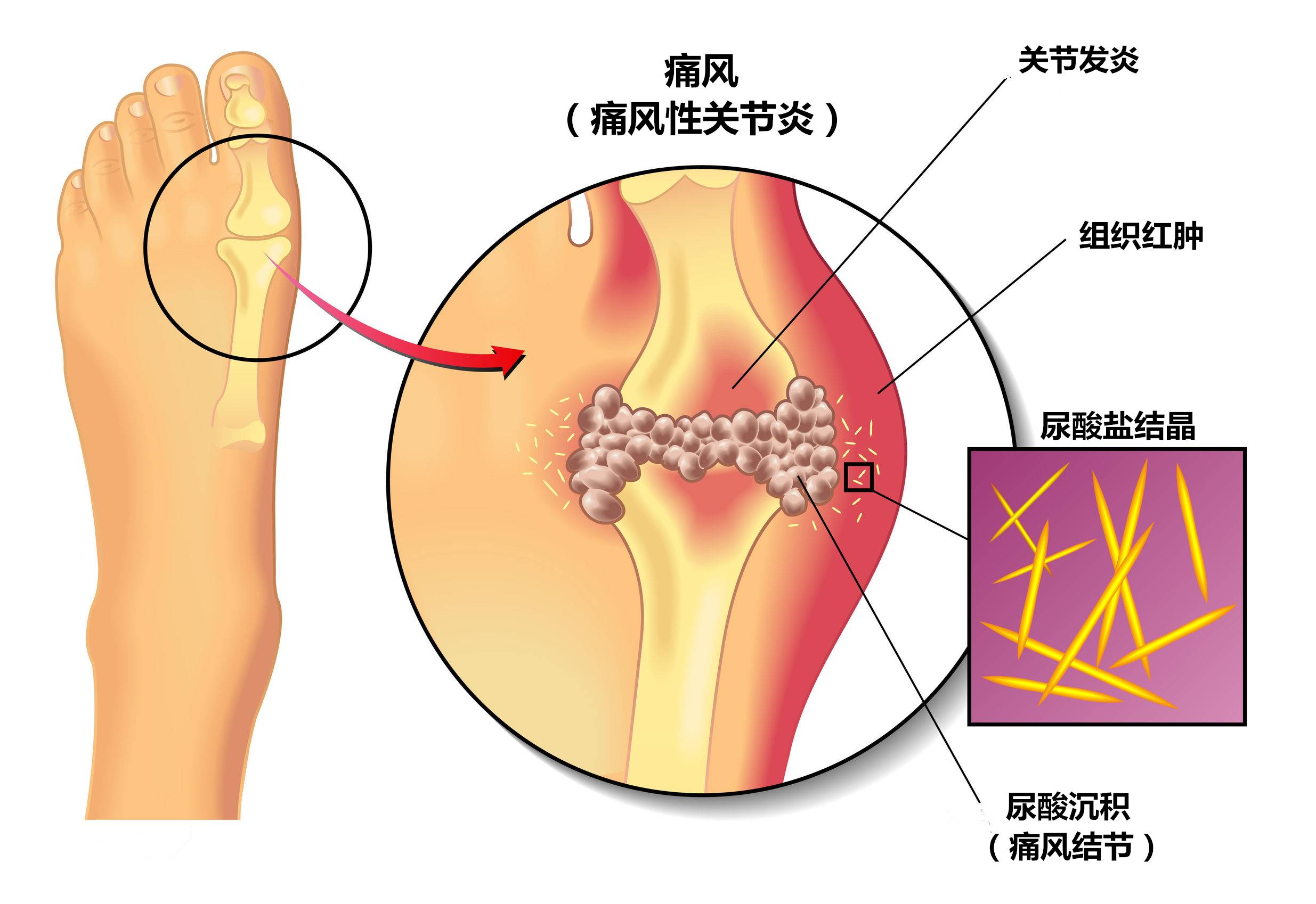 痛风石2.jpeg