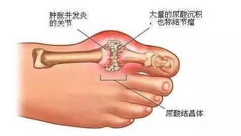 高尿酸生活中饮食应该注意哪些？如何控制？