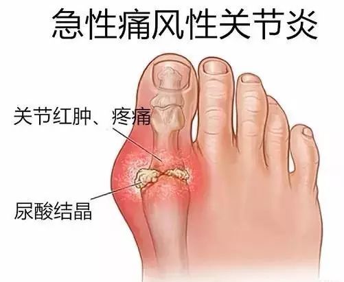 痛风性关节炎预防及治疗措施有哪些方法？