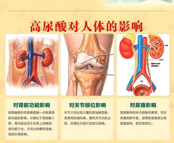 尿酸高的危害是什么？生活中该怎么降尿酸高？