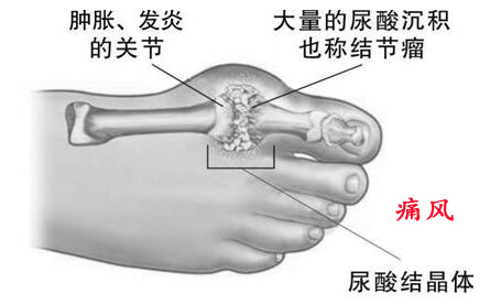 痛风9.jpg