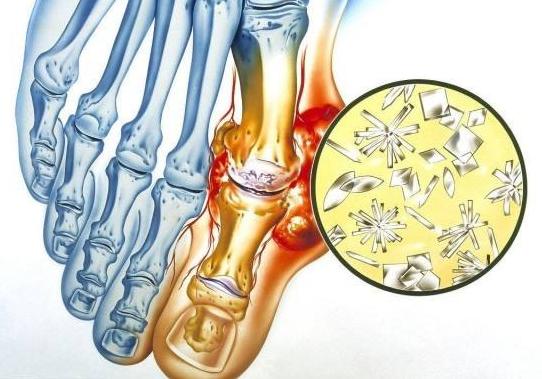 痛风能喝苏打水吗？喝苏打水能降尿酸吗？