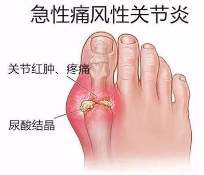 痛风急性期怎么办？痛风急性期用什么药好得快？