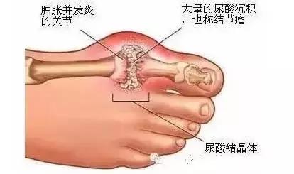 痛风疼痛怎么办？痛风病人能吃小分子肽吗？