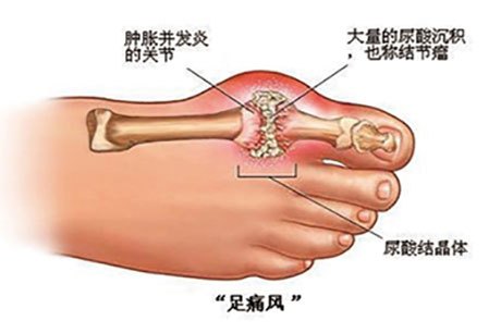 痛风为什么从脚开始疼痛？痛风发作如何快速缓解疼痛？