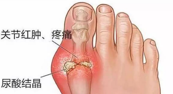 益生菌可降低痛风发病风险还对糖尿病有辅助作用