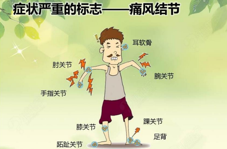 尿酸升高就一定会得痛风吗？关节红肿是不是痛风？