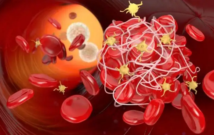 纳豆纤溶酶与预防和溶解血栓