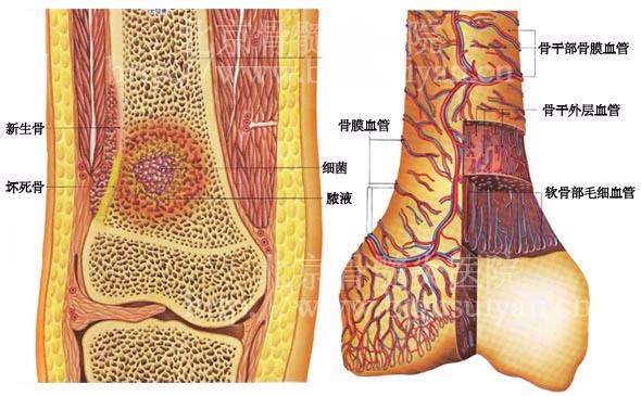 骨髓炎的症状表现,骨髓炎怎么引起的？