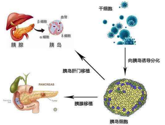 干细胞再生胰岛.png