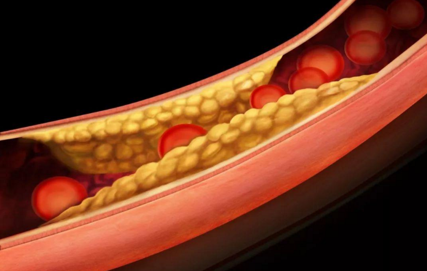 高脂血症怎么治疗和预防，喝生物活性肽能治疗高脂血症吗