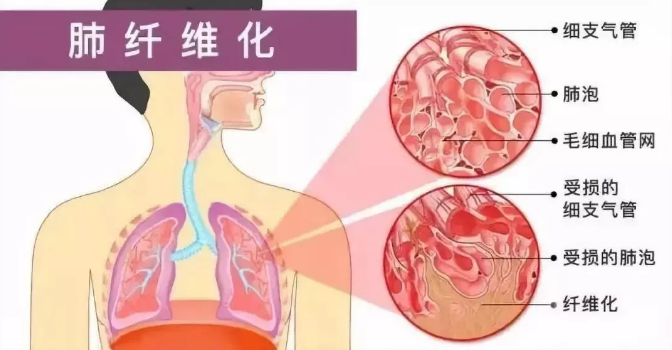 干细胞移植在肺纤维化治疗中的应用