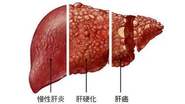 什么是肝硬化？干细胞在肝硬化治疗中的应用实况