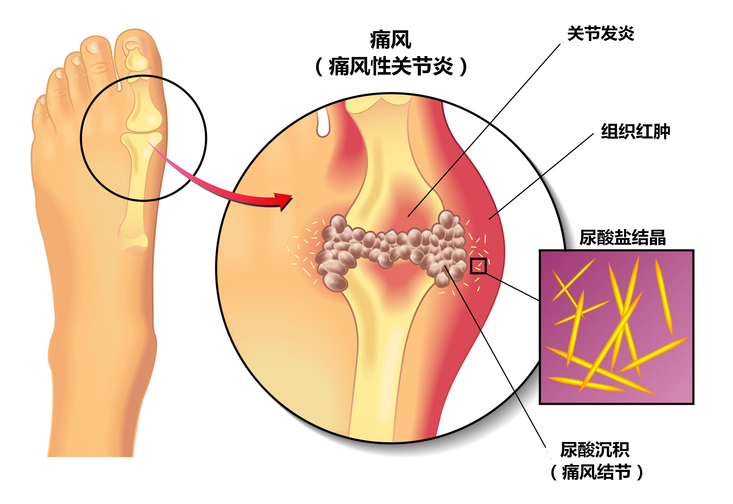 痛风是怎么来的,痛风治疗的方法?