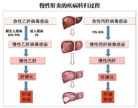 慢性肝炎的症状及表现,慢性肝炎可以治愈吗?