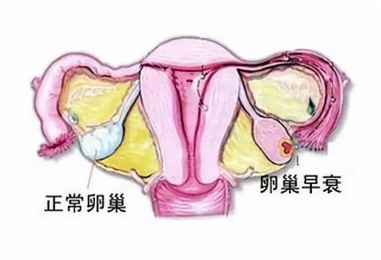 女性卵巢早衰的原因和表现,卵巢早衰吃什么补充雌激素?