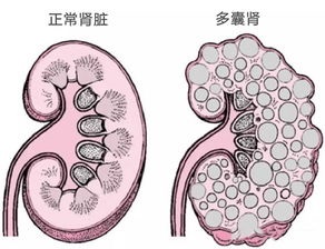 肾囊肿形成的原因,肾囊肿吃什么能消除？