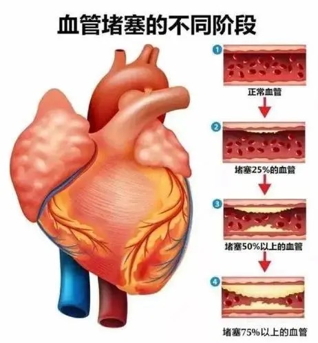 心血管堵塞怎么调理比较好,心血管堵塞如何预防?