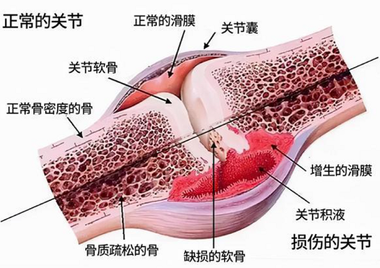 软骨损伤关节炎可以吃牛骨胶原蛋白肽吗？