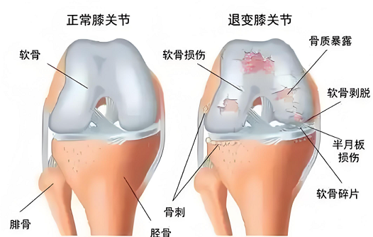 牛骨胶原蛋白肽对骨病好处,膝关节炎可以吃牛骨胶原蛋白肽吗?