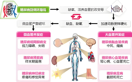 糖尿病微循环障碍可以改善吗?
