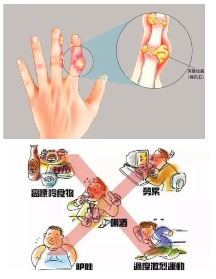 痛风尿酸高形成的原因,痛风高尿酸吃什么调理？