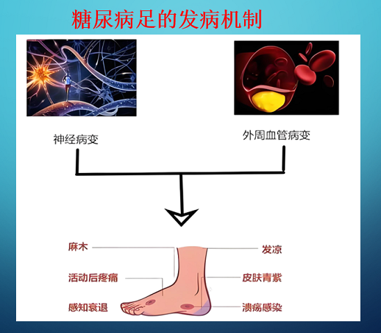 糖尿病足伤口不愈合怎么办,活性多糖对促进糖尿病足伤口愈合的作用.