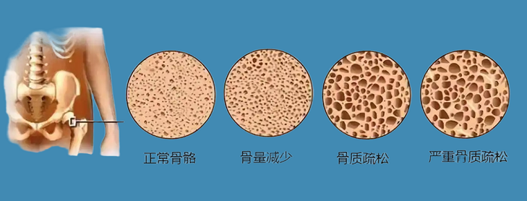 牛骨髓肽与骨质疏松的功效,预防骨质疏松可以吃牛骨髓肽吗？