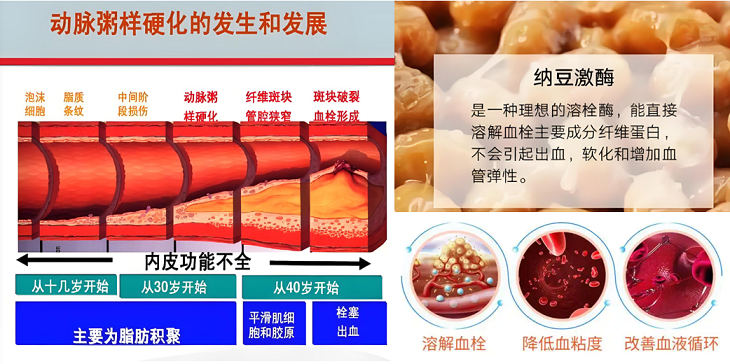 纳豆激酶真的能消除血栓斑块,纳豆激酶能软化血管的作用.
