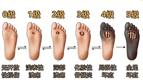 生物活性多糖与糖尿病足.png